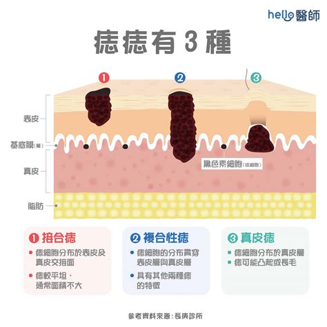 身體 痣|痣形成的原因？痣長毛、痣變多變大是痣病變？5招判。